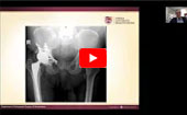 Challenging Cases in THR - Guest Faculty Lecture at American Hip Institute & Orthopedic Specialists: Dr. Nicholas Brown of Loyola University