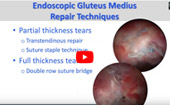 American Hip Institute’s Dr. Domb presents open gluteus medius repair with allograft augmentation