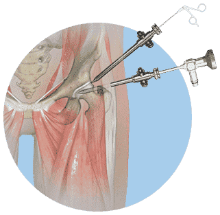 Hip Arthroscopy in American Hip Institute & Orthopedic Specialists