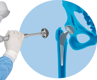 Robotic Hip Replacement in American Hip Institute & Orthopedic Specialists