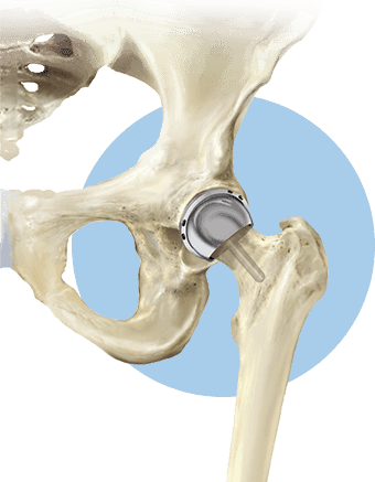 Hip Resurfacing in American Hip Institute & Orthopedic Specialists