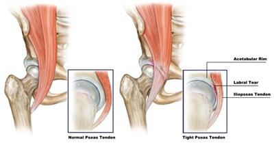 Iliopsoas Impingement