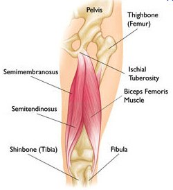 Proximal Hamstring Tear