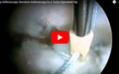 Hip
              Arthroscopy Revision Arthroscopy to a Twice Operated Hip