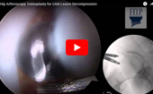 Hip
              Arthroscopy Osteoplasty for CAM Lesion Decompression