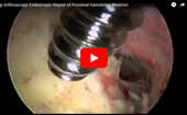 Hip
              Arthroscopy Endoscopic Repair of Proximal Hamstring Avulsion
