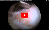 Hip
              Arthroscopy Chondroplasty and Osteoplasty of CAM Lesion