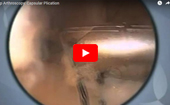 Hip
              Arthroscopy Capsular Plication