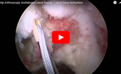 Hip
              Arthroscopy: Acetabular Labral Repair - Labral Base Refixation