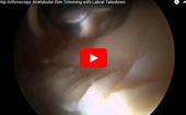 Hip
              Arthroscopy: Acetabular Rim Trimming with Labral Takedown