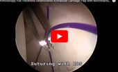 Hip
              Arthroscopy: Full Thickness Delaminated Acetabular Cartilage Flap with Microfracture