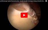 Hip
              Arthroscopy: Labral Reconstruction - Double Bundle Technique Using a Gracilis Tendon Autograft