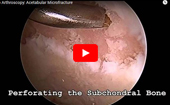Hip
              Arthroscopy: Acetabular Microfracture 
