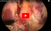 Hip
              Arthroscopy: Sciatic Nerve Release