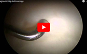 Diagnostic Hip Arthroscopy
