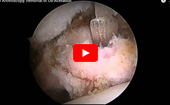 Hip
              Arthroscopy: Removal of Os-Acetabuli