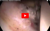 Hip
              Arthroscopy Iliopsoas Lengthening
