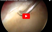 Hip
              Arthroscopy Chondral Damage The Wave sign