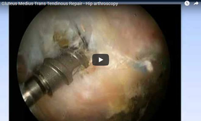 Gluteus Medius Trans Tendinous Repair