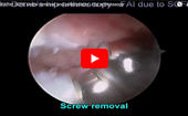 FAI
              after SCFE screw removal and osteoplasty