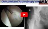 Dysplasia: Arthroscopic Indications, Dr. Benjamin Domb, Chicago Hip Symposium (2013)