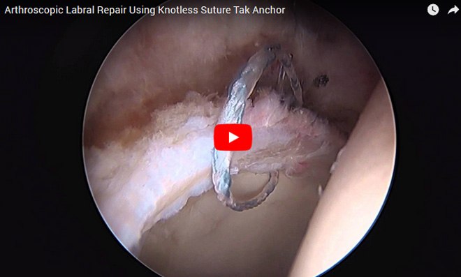 Arthroscopic Labral Repair Using Knotless Suture Tak Anchor