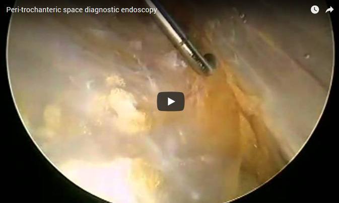 Peri-trochanteric space diagnostic arthroscopy