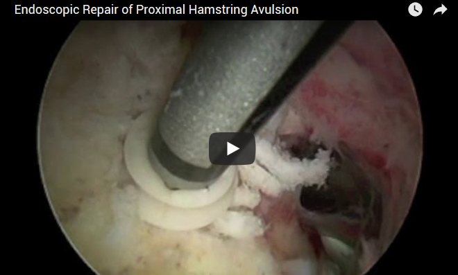 Endoscopic Repair of Proximal Hamstring Avulsion