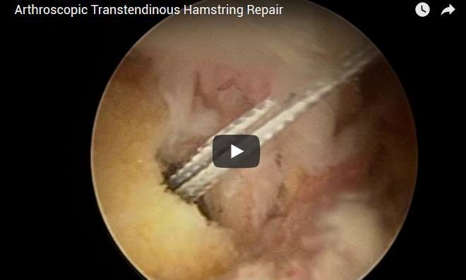 Arthroscopic Transtendinous Hamstring Repair