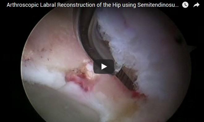 Arthroscopic Labral Reconstruction of the Hip using Semitendinosus Allograft