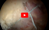 Gluteus
              Medius Repair - Knotless Suture Staple Technique
