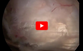 Gluteus
              Medius Repair: Double-Row Suture-Bridge