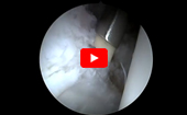 Hip
              Arthroscopy Circumferential Labral Reconstruction, Knotless Pull-Through Technique