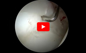 Hip
              Arthroscopy Capsular Elevation
