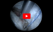 Hip
              Arthroscopy Labral Augmentation